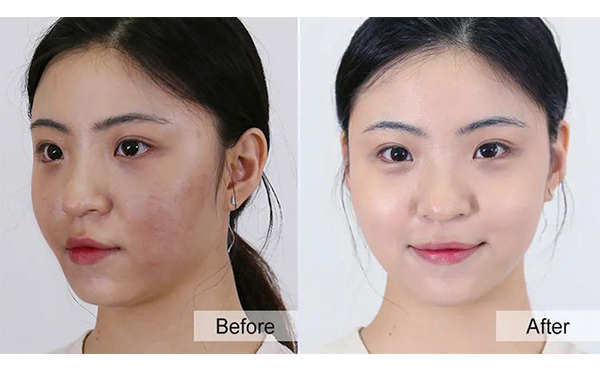 美白針有什么優(yōu)勢(shì)？