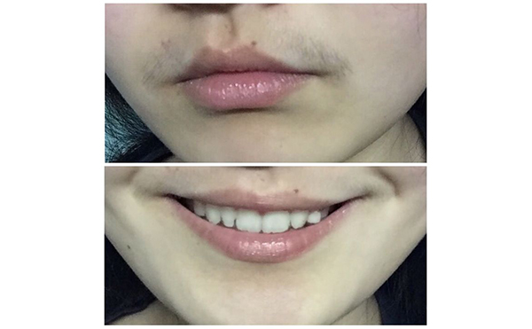 冰點(diǎn)面部脫毛會(huì)影響毛孔嗎？