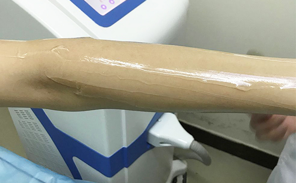 冰點脫毛的步驟是什么?有哪些需要注意的?