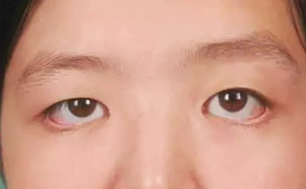 眼袋修復(fù)一般多少錢?眼袋修復(fù)術(shù)后怎么護理?