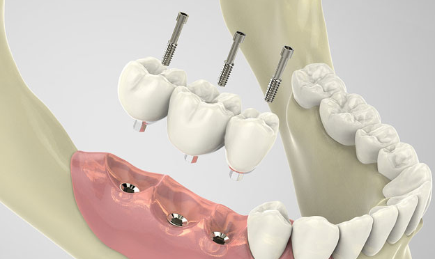 種植牙多少錢一顆牙？