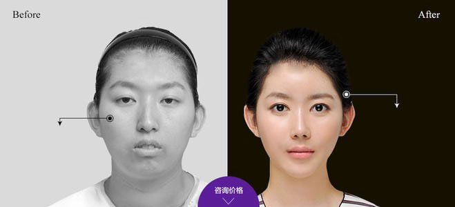 下頜角整形的方法有哪些？