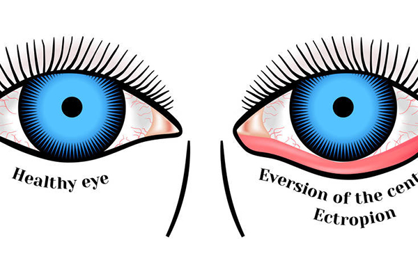 去眼袋安全嗎?去眼袋失敗怎么修復(fù)?