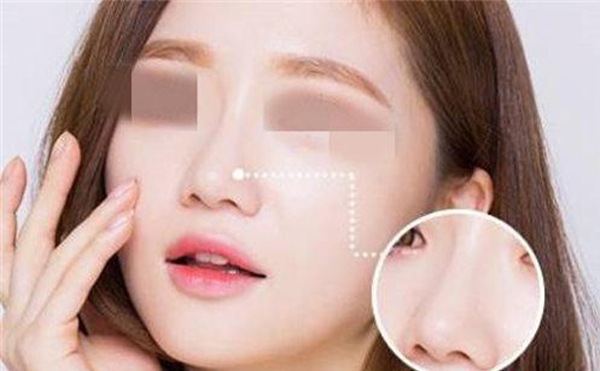 合肥壹加壹整形：出現以下7種情況就是隆鼻失敗了