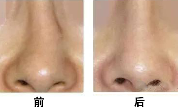 歪鼻矯正術(shù)后需要注意哪些方面?
