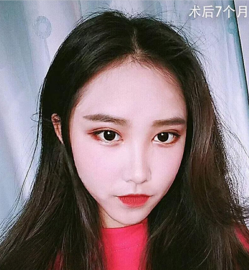 微創(chuàng)雙眼皮術(shù)后七個(gè)月效果