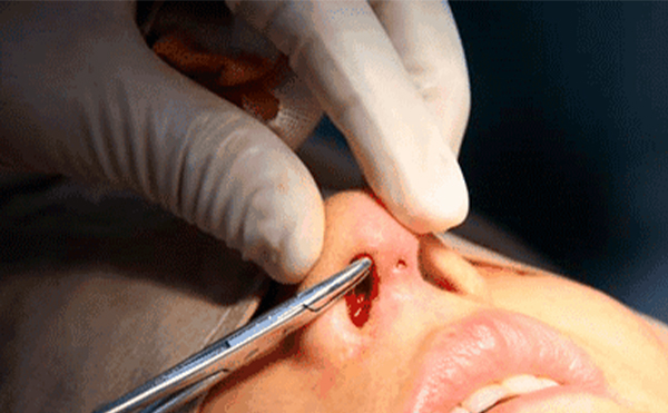 在原來的假體上，可不可以重新調(diào)整或者更換一下?