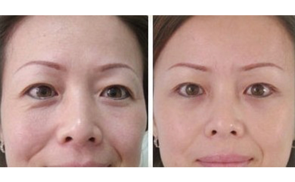 做眼袋可以去皺紋嗎?手術(shù)后周圍皮膚青紫怎么辦?