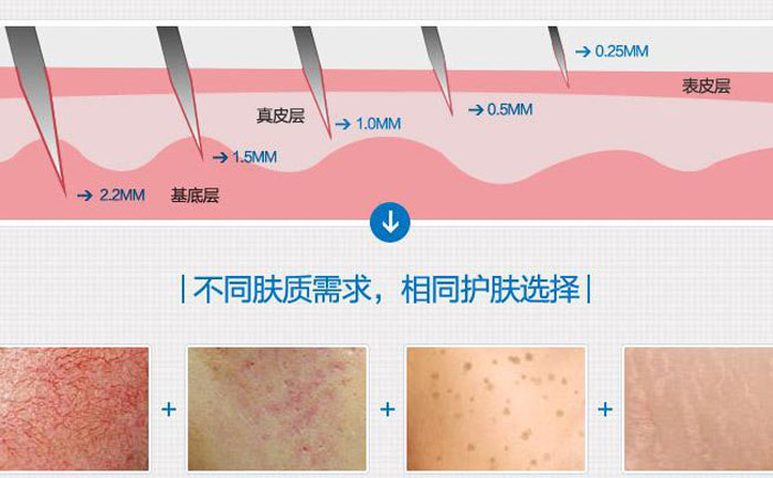 微針去痘坑多少錢一次？