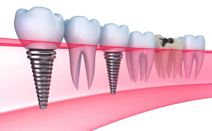 牙齒種植大概費(fèi)用是多少？牙齒種植多少錢一顆