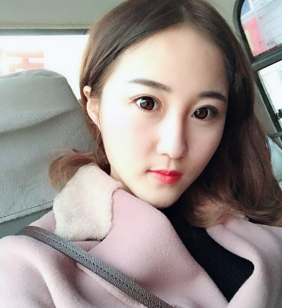 雙眼皮修復(fù)效果對比圖4