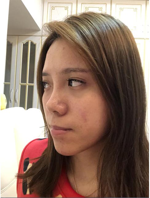 肋軟骨鼻綜合案例:術(shù)前效果