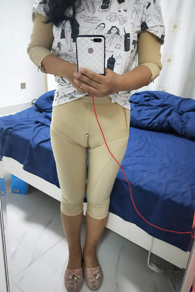 大腿環(huán)吸術恢復期