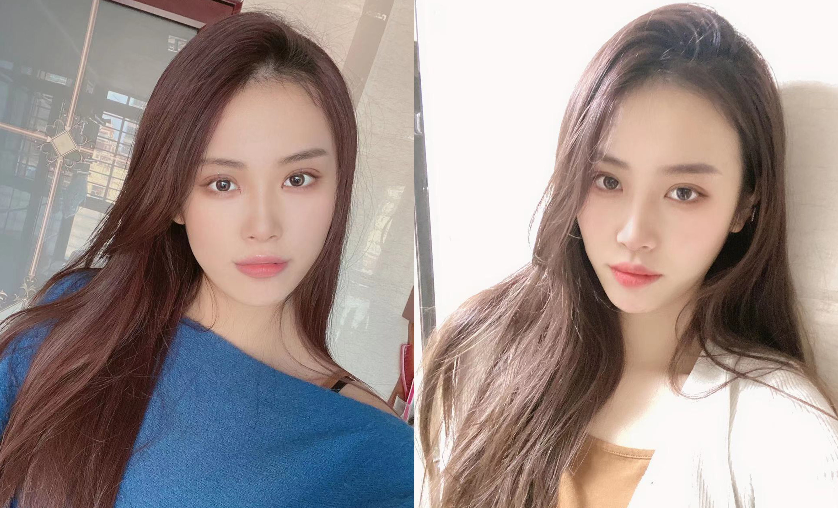 寧波藝星熱瑪吉術后一年效果反饋3