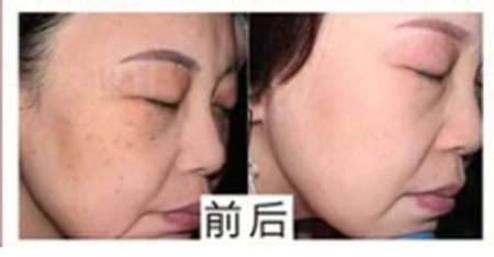 華韓醫(yī)療美容醫(yī)院祛斑案例對比2