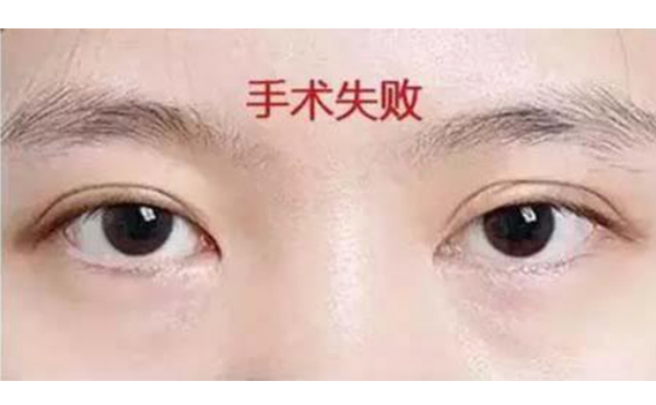 韓式三點(diǎn)雙眼皮的優(yōu)點(diǎn)是什么?術(shù)后怎么避免不對稱?