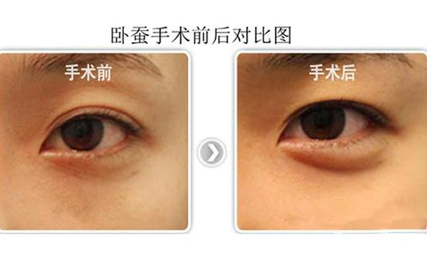 玻尿酸豐臥蠶好不好?哪些人適合豐臥蠶?