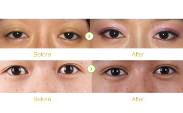 三角眼矯正有哪些優(yōu)點?哪些人不適合做三角眼矯正?