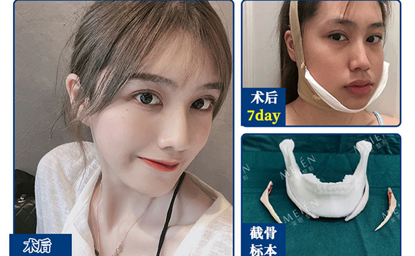 下頜角整形手術(shù)有風(fēng)險嗎?有什么風(fēng)險?