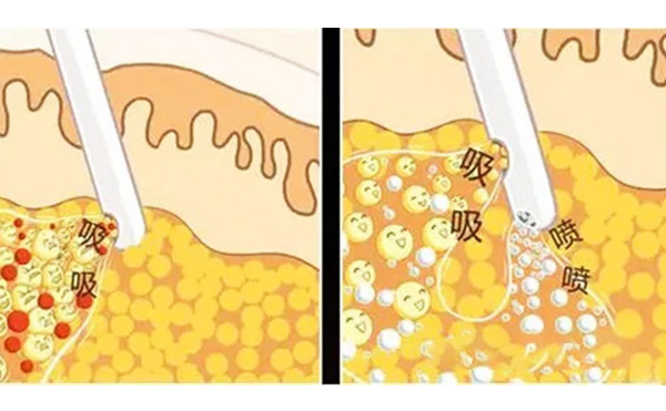 什么是水動(dòng)力吸脂？