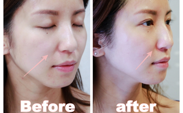 電波拉皮是什么原理？