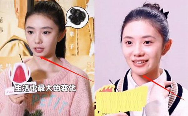 玻尿酸隆下巴整形攻略【優(yōu)勢、適宜人群、注意事項】