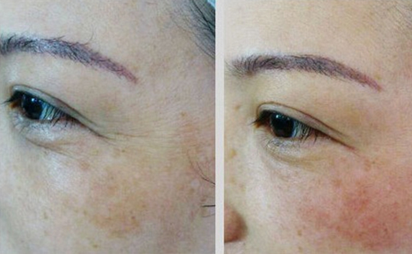 魚尾紋除皺哪些方法好？