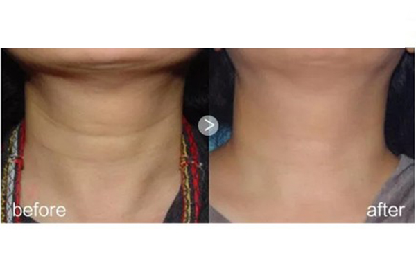 哪些人不能做嗨體？