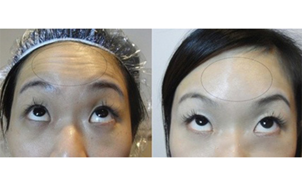 玻尿酸能去抬頭紋嗎？