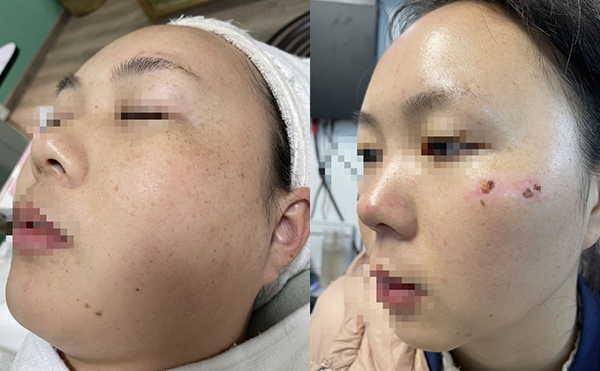 彩光嫩膚有沒有副作用？