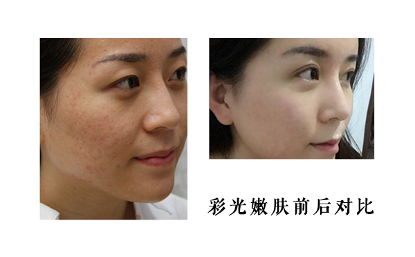 皮膚薄能做彩光嫩膚嗎？