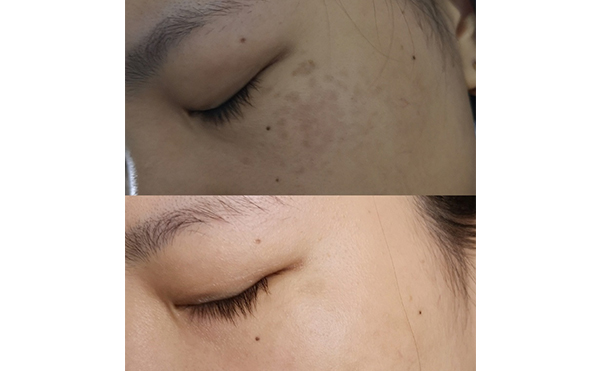 激光美白能維持多久？