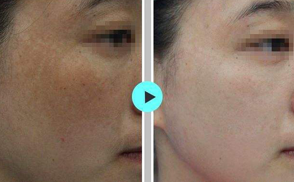 激光祛斑會使皮膚變薄嗎？