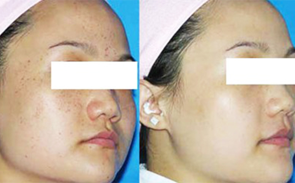 激光祛斑治療一次要多久？