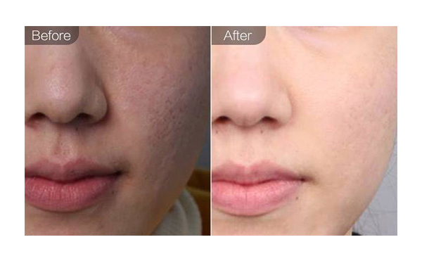 e光嫩膚適合哪些人？