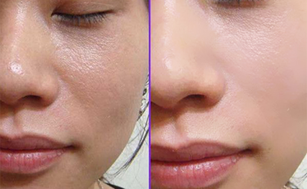 做e光嫩膚前要注意什么？