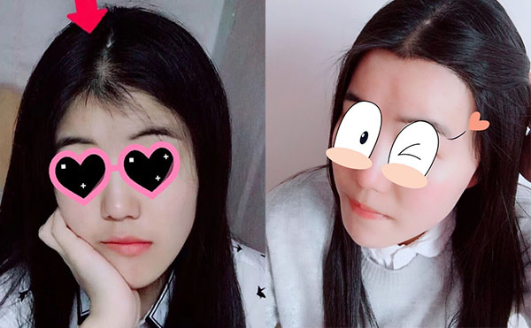 冰點(diǎn)脫毛發(fā)際線怎么樣？