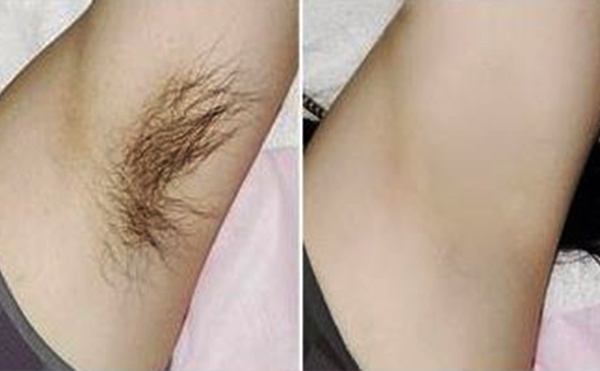 光子脫腋毛有什么優(yōu)勢？