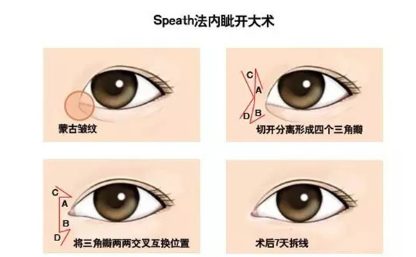 開內(nèi)眼角復(fù)雜嗎?手術(shù)過程是什么?