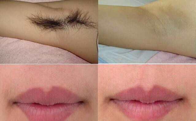 冰點(diǎn)脫毛大概多少錢？