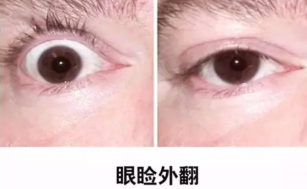 醫(yī)美技術(shù)越來越發(fā)達(dá)，不少愛美的人本著變美的心情滿懷期待地去做雙眼皮、開眼角等項(xiàng)目，不料整容不成、反倒毀容，后悔也來不及。有些做雙眼皮的姑娘術(shù)后出現(xiàn)眼瞼外翻的情況，那眼瞼外翻是什么意思?上眼瞼外翻如何修復(fù)?