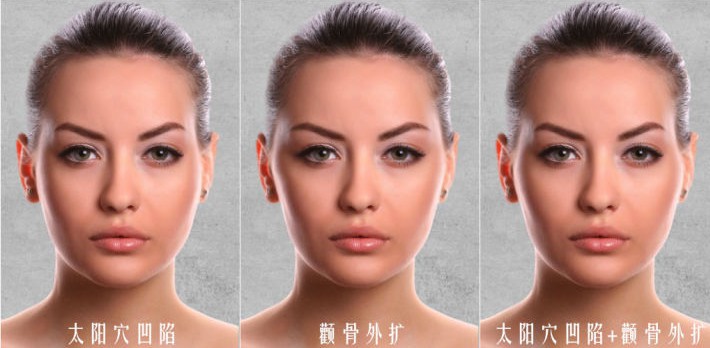 顴弓外擴(kuò)嚴(yán)重