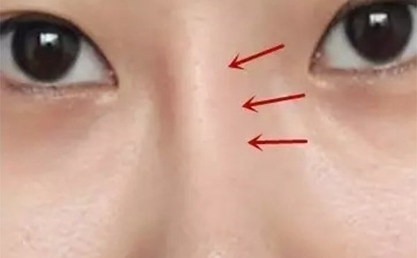 假體隆鼻時(shí)間長(zhǎng)了出現(xiàn)假體移位等并發(fā)癥后該怎么辦？