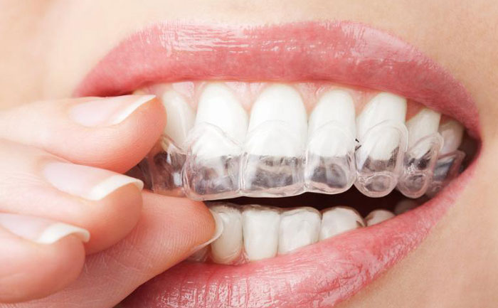 手術(shù)矯正牙齒費(fèi)用大概多少？手術(shù)矯正牙齒怎么矯正？