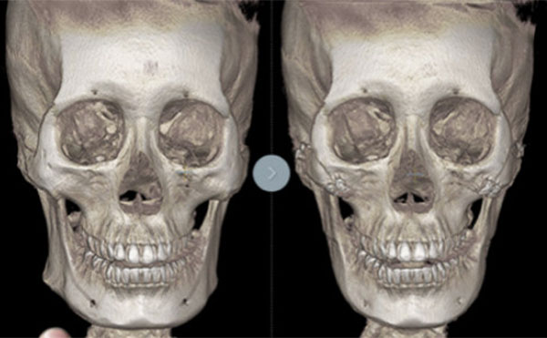泉州海峽整形醫(yī)院：這四種人做面部輪廓整形效果絕了