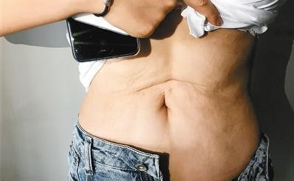 腹部吸脂術(shù)后為什么會(huì)凹陷?好修復(fù)嗎?