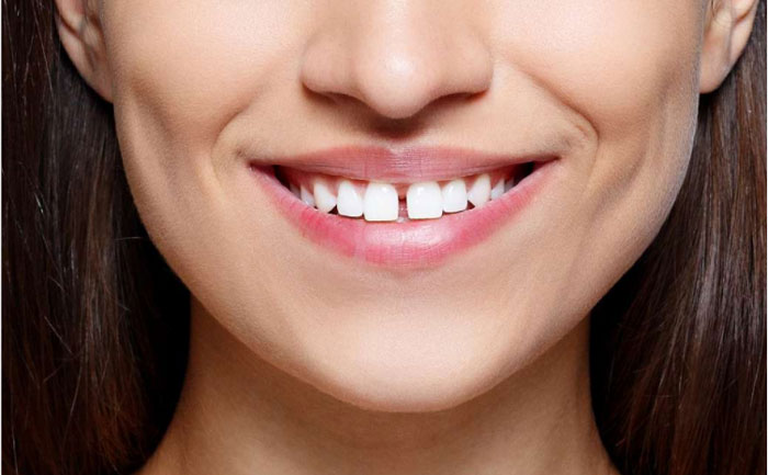 牙縫大可以矯正嗎？