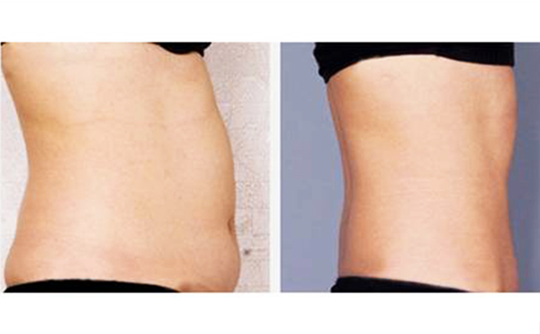 腰腹吸脂安全性高嗎？