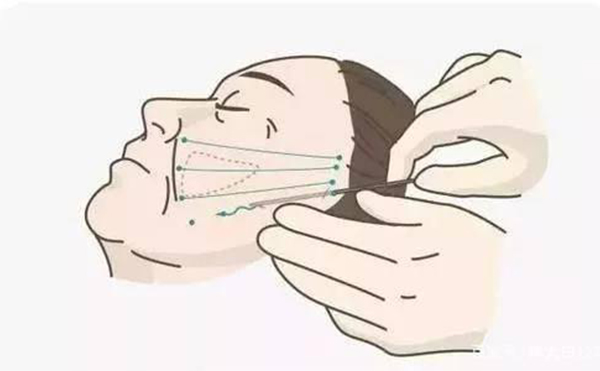 線雕提升好嗎？