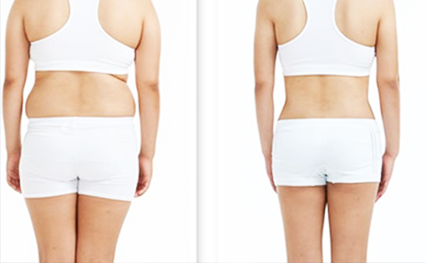 腹部吸脂手術(shù)有哪些常見問題？